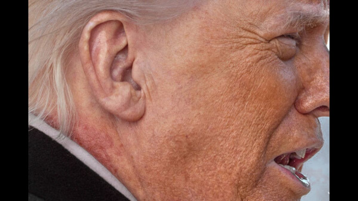 Is Donald Trump’s neck rash linked to a skin condition? What we know so far